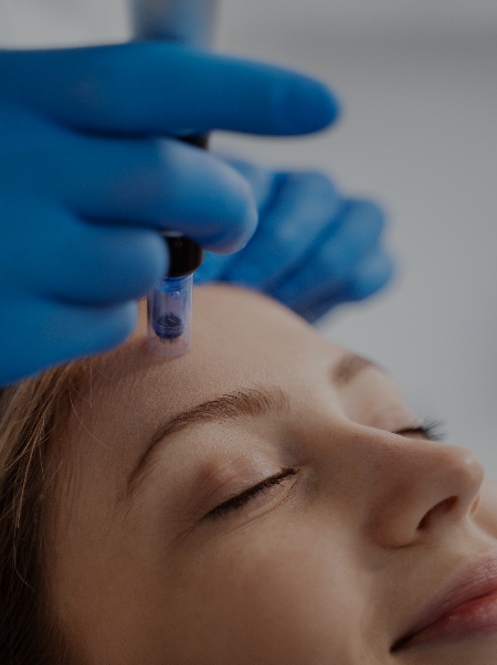 microneedling
